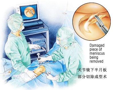 半月板撕裂手术后会有哪些症状,半月板撕裂时间长了可以做手术吗