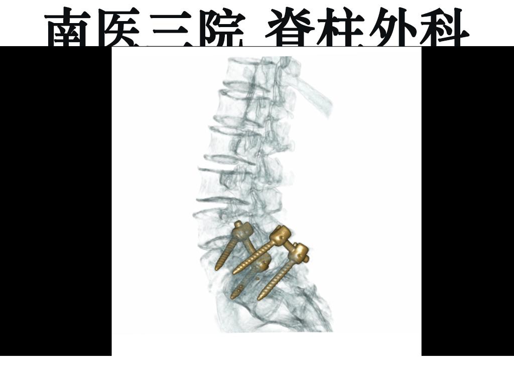 峡部裂导致滑脱有没有痊愈的可能,青少年峡部裂做哪种手术最好