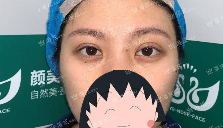 肿眼泡抽脂肪埋线双眼皮效果,肿眼泡割双眼皮长脂肪