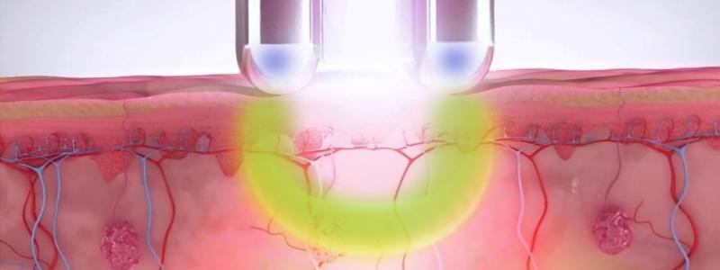 赛*龙诺**脉冲激光,光电传奇，这是网友最关心的一点