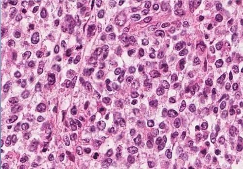 赵忠祥鳞状细胞癌长在哪,赵忠祥鳞状细胞癌什么症状