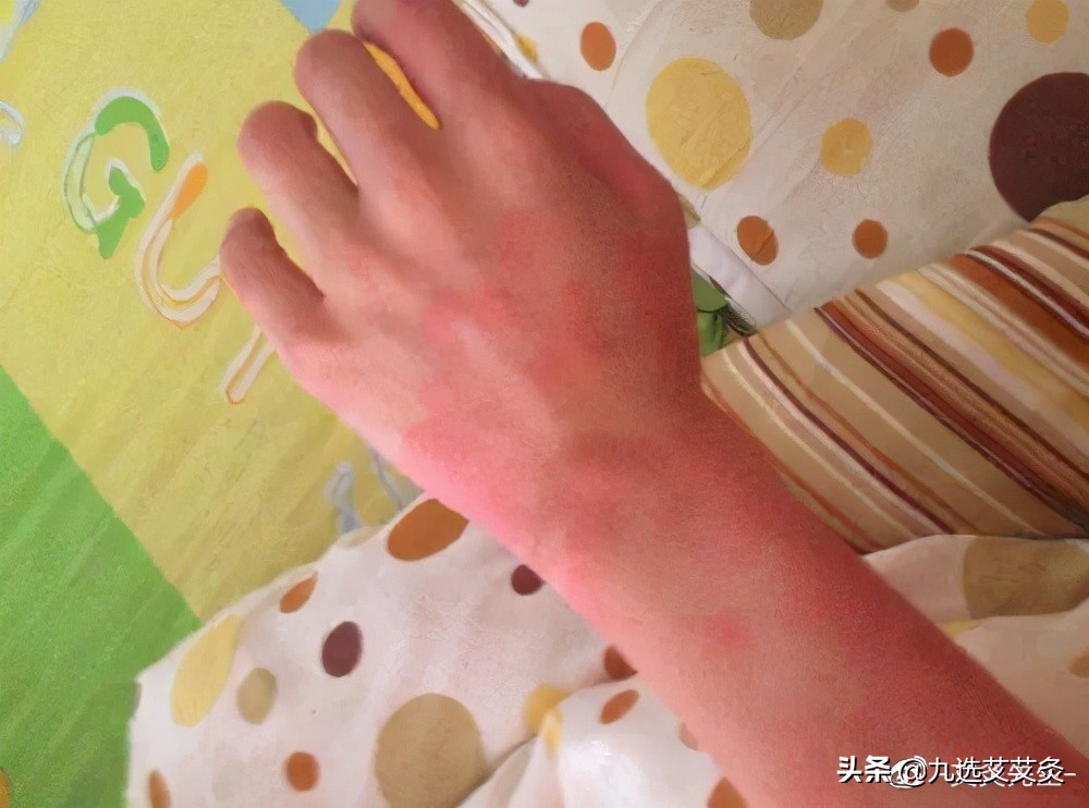 面部艾灸后皮肤痒和起疙瘩,艾灸治疗皮肤肿痒