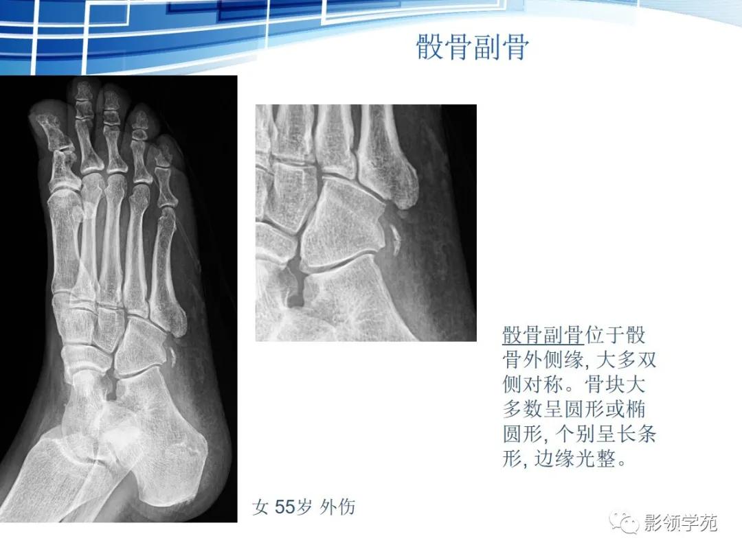 桡骨远端骨折引起尺骨变异,撕脱骨折一个月无明显骨痂形成