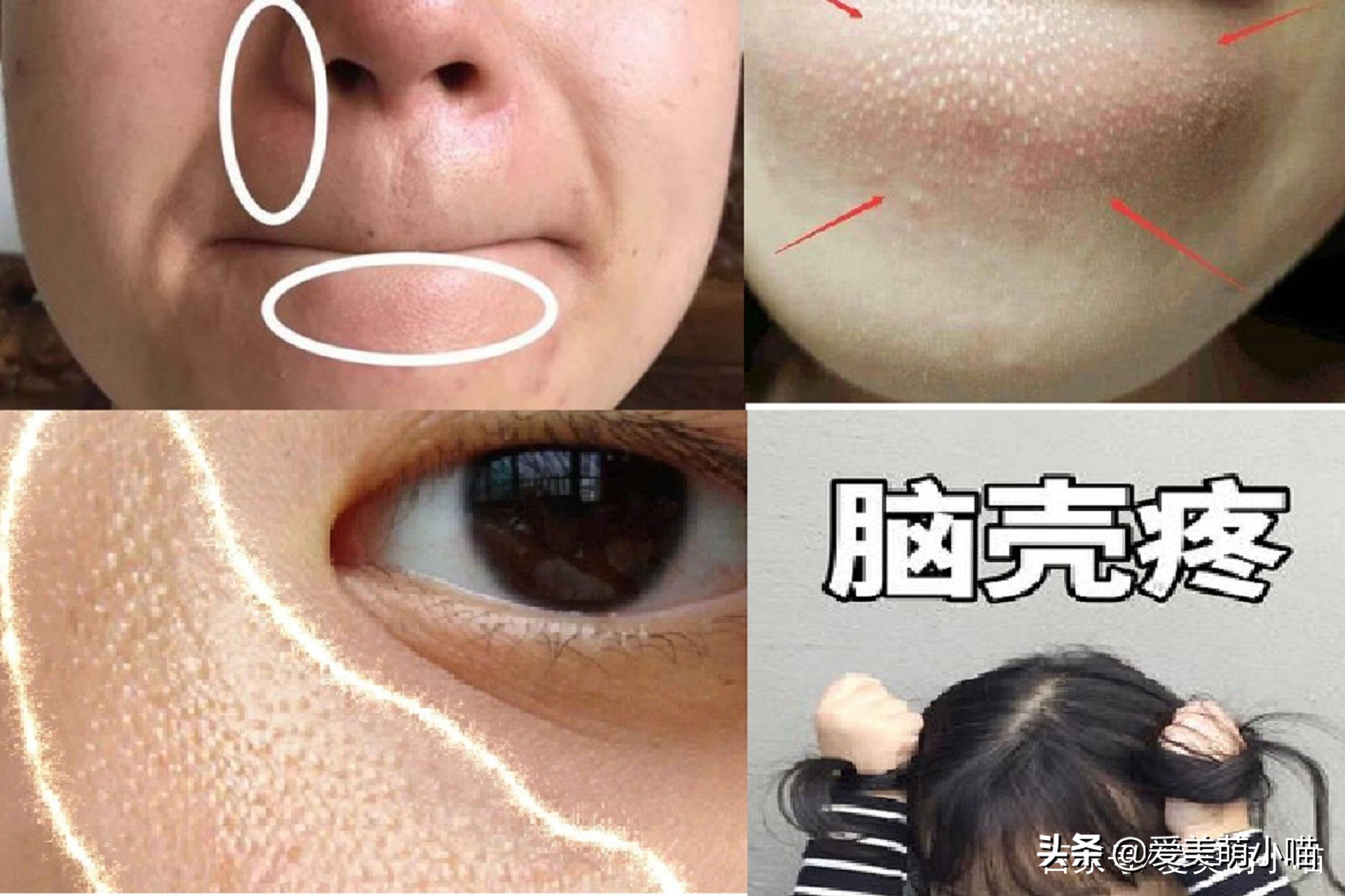 下巴有白色凸起物怎么消除,下巴凸起的小颗粒怎么消除