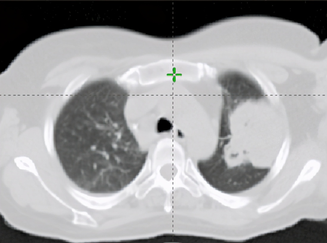 哈医大肿瘤医院化疗放疗在哪里,哈医大一院手术治疗肺癌
