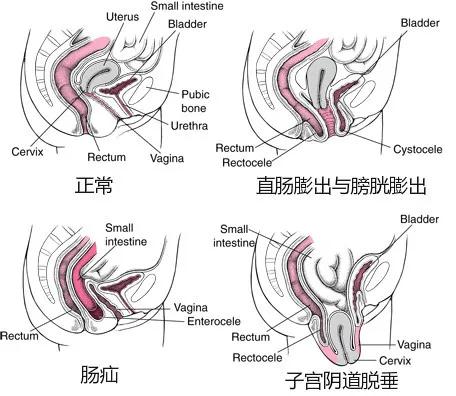 笑到尿裤子该怎么治疗,医生说尿尿多怎么办