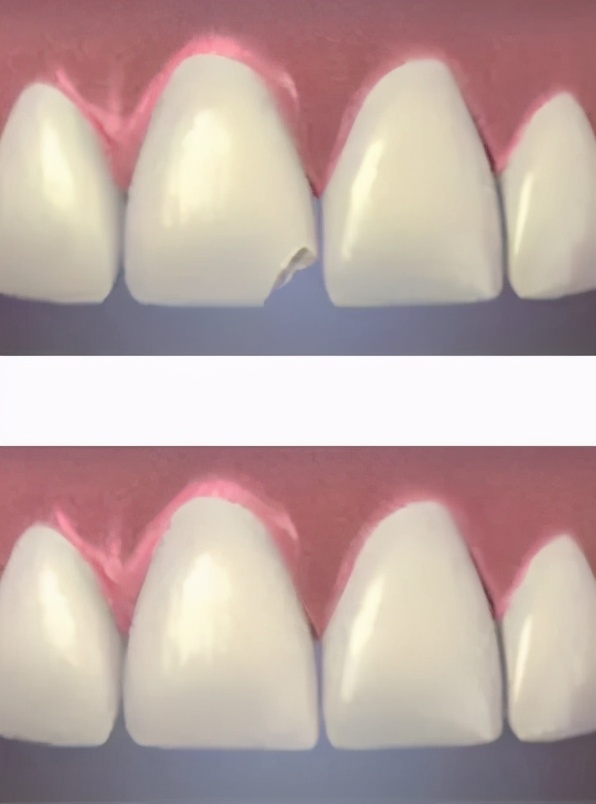 牙齿意外脱落补救方法,牙齿折断怎么判断有没有露牙神经