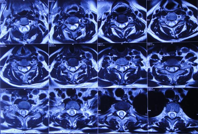 脑出血后脑积水会造成意识不清吗,脑出血后脑积水发高烧危险期多久