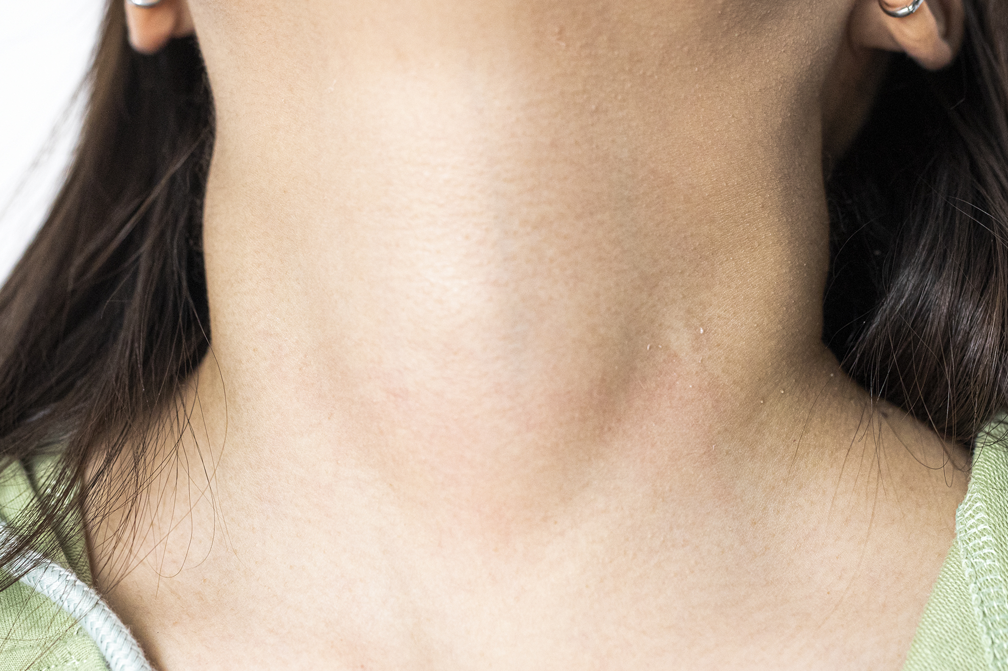 解决黑头的2种药,解决黑头的最好方法