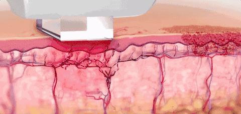 真人体验美容院,光子嫩肤美容院真实体验