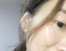 脸上红血丝怎么修复可以彻底治愈,血丝怎么能快速消除