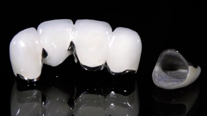 烤瓷牙贴片全口价格,贴片牙齿和烤瓷牙有哪些伤害