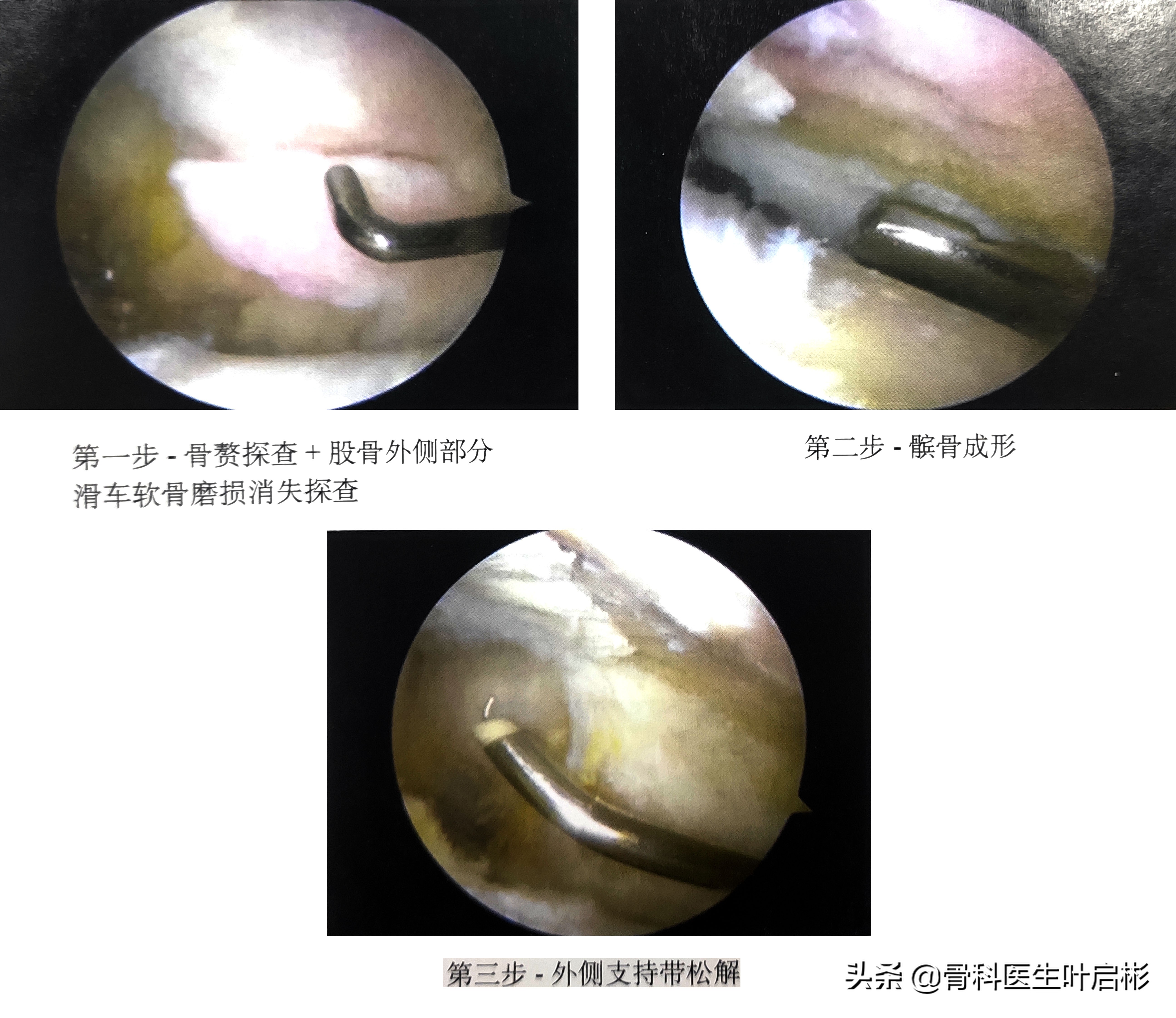 人工膝关节术中髌骨置换操作,微创手术修复关节软骨