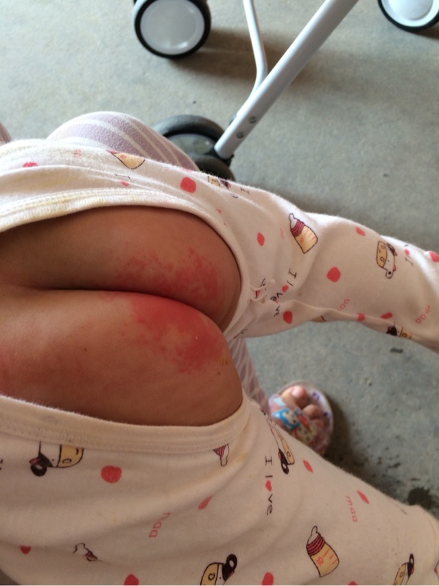 宝宝红屁股的救星,宝宝红屁股了怎么办