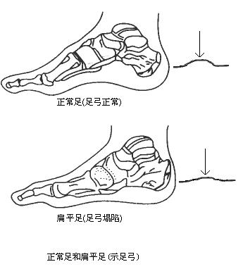 导致女性出现小腿粗肿的肌肉型小腿的三个原因及解决方法