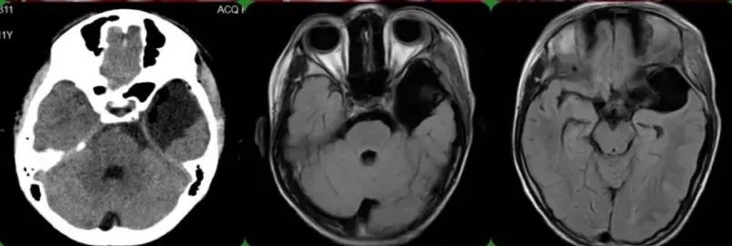 小孩发育脑部囊肿,小孩蛛网膜囊肿会影响智力发育吗