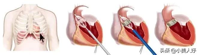 沛嘉医疗和开拓药业的区别,沛嘉医疗前景如何