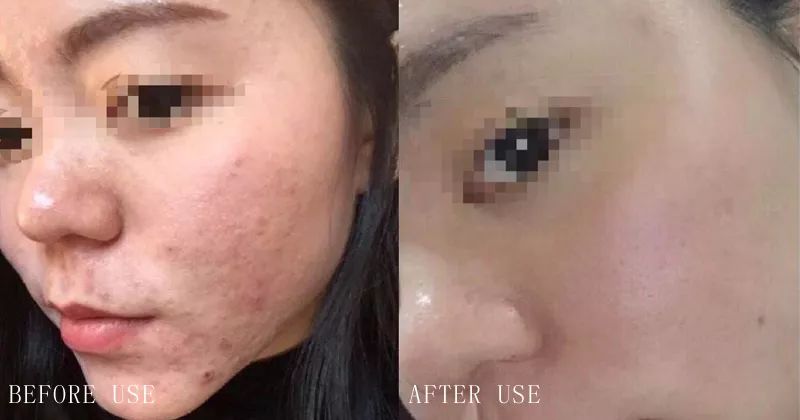 没做医美可用可复美械字号面膜吗,械字号和医美面膜哪个好用