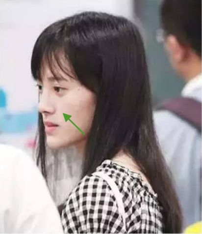 贵族手术的好处,鼻基底手术失败凹陷怎么改善