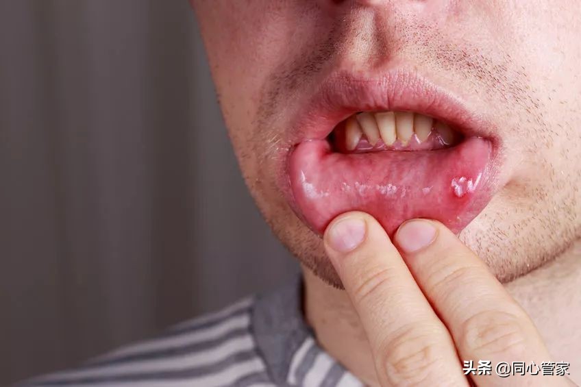 胃溃疡伴有冠心病吃什么药,吃冠心病的药引起胃痛怎么办