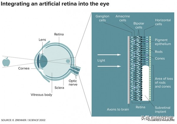 治疗视网膜色素变性的新研究成果,视网膜色素变性目前新型研究