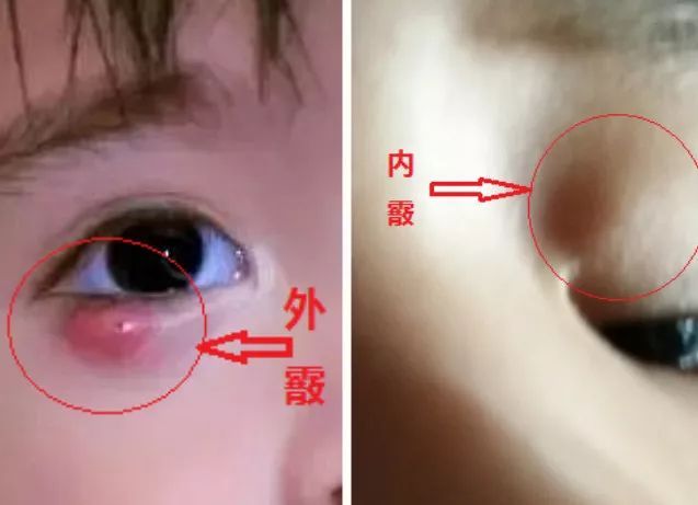 眼睛长疙瘩红肿又疼怎么办,血脂高眼睛上长疙瘩怎么办