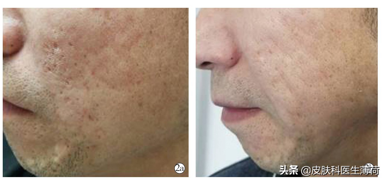 长痘了挤了留了坑怎么办,痘没了留下个疙瘩怎么回事