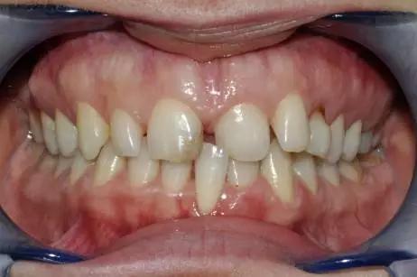 四十多岁门牙缝隙越来越大怎么办,儿童门牙缝隙越来越大原因