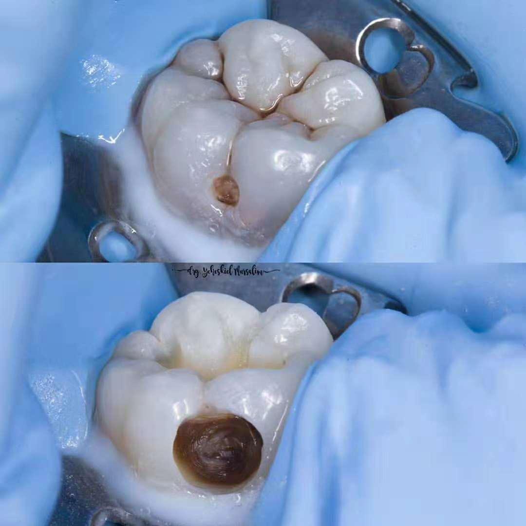 想要补个牙反而被磨了个大洞,大牙牙洞很大很深能补吗