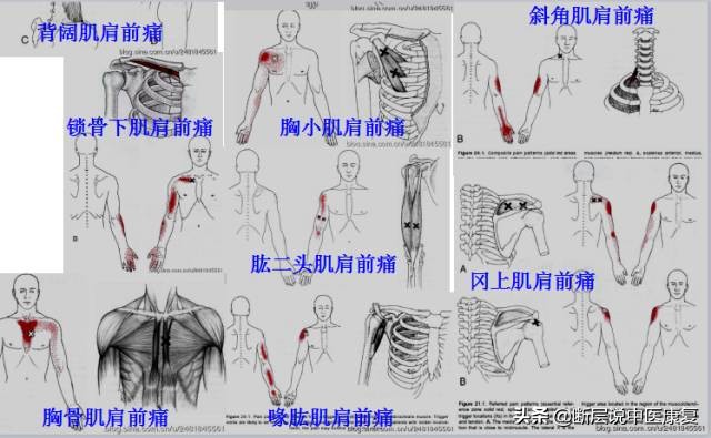 激痛点挂图,激痛点疗法笔记