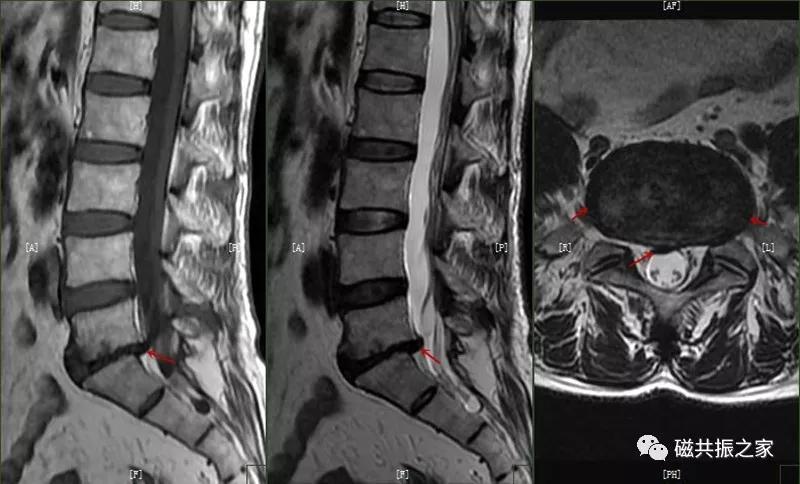 腰椎有哪些病变,腰椎病变有几种