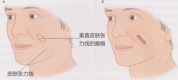 如果受伤了怎么处理才不会留疤,受伤不想留疤不能吃什么
