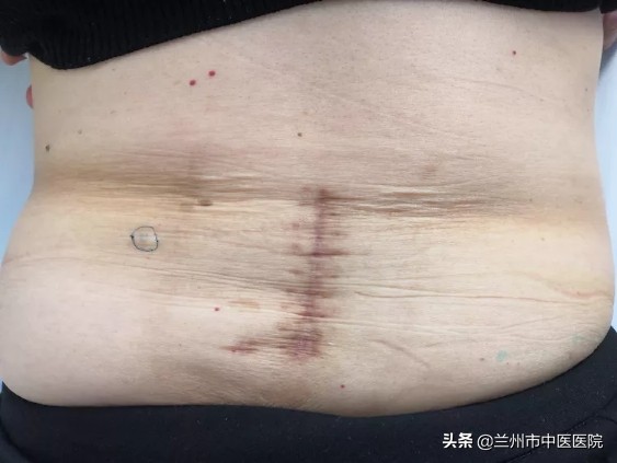 腰椎滑脱手术五十天伤口痛正常吗,银质针能治腰椎滑脱吗