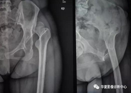 儿科先天性髋关节脱位的分型为,先天性髋关节脱位分级