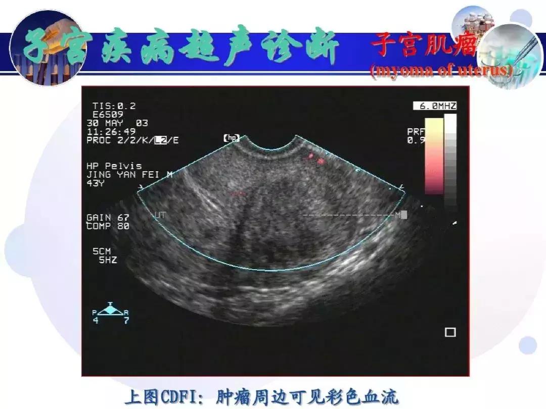 纯干货！子宫及附件解剖和超声诊断