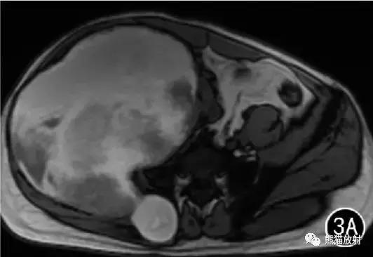 假性血友病什么症状,血友病病理