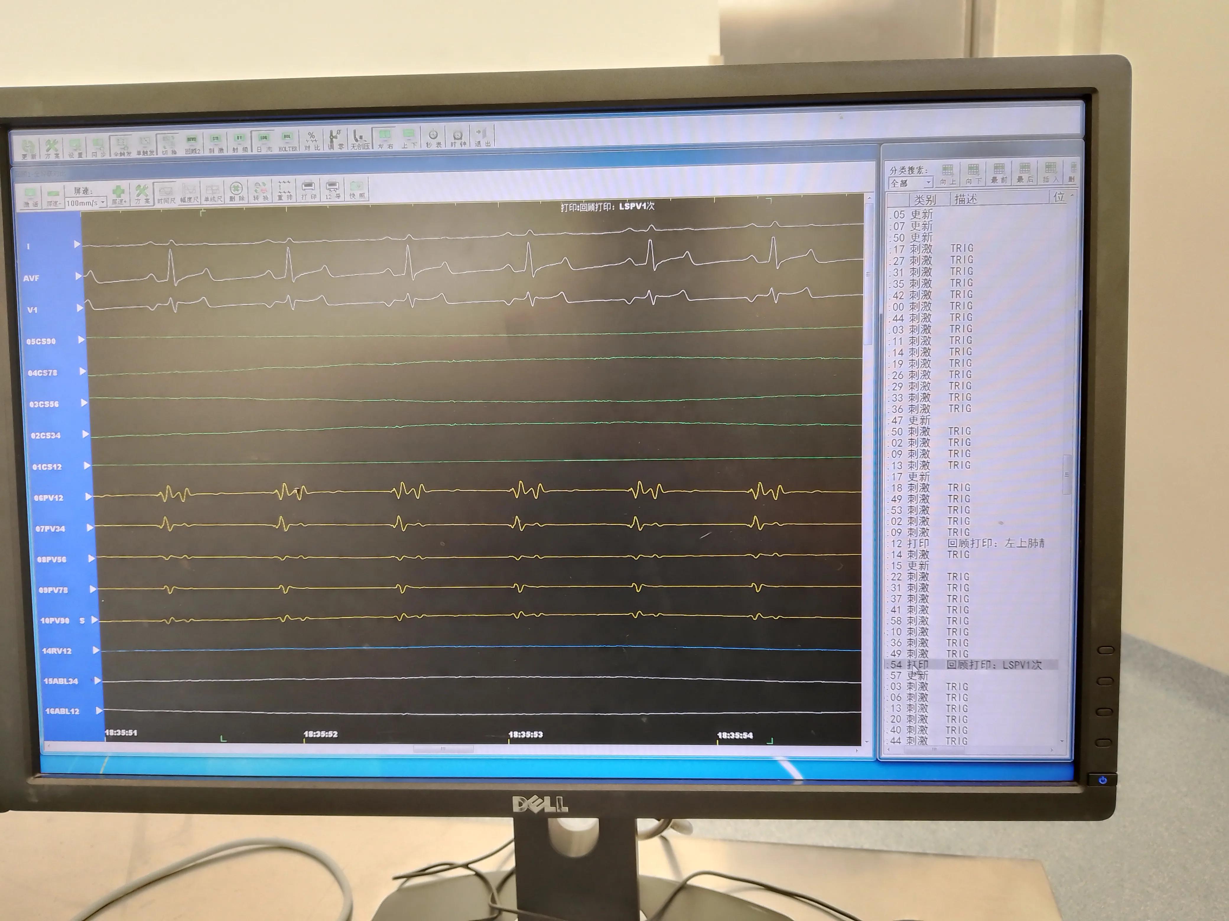 房颤射频消融术器械有哪些,脉冲消融治疗房颤品牌