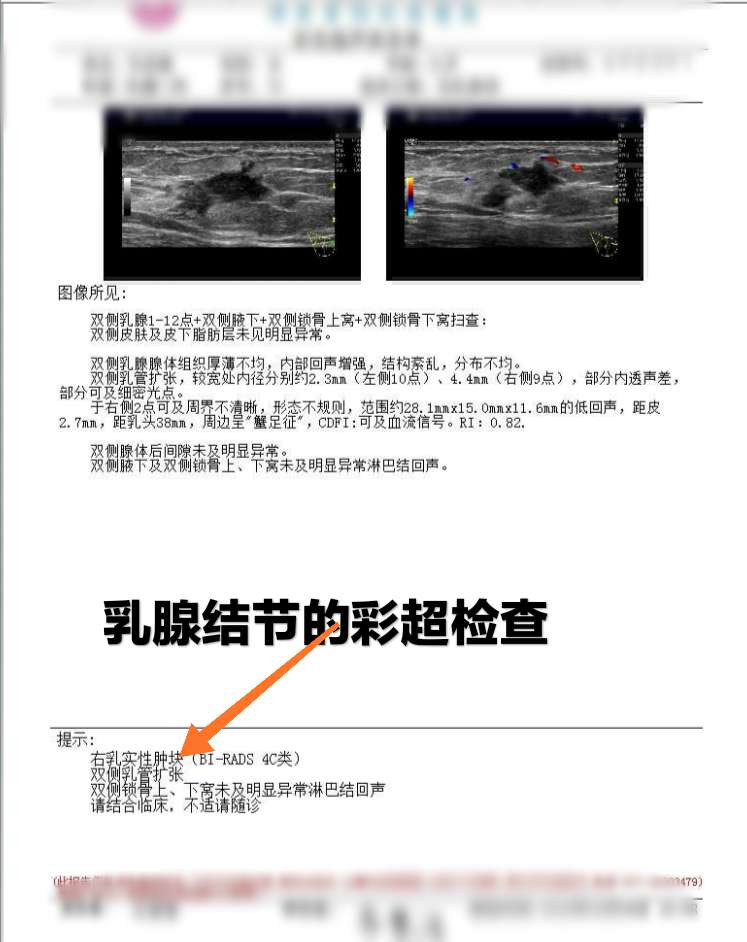 乳腺结节三级有一辈子不癌变的吗,乳腺结节属于病吗