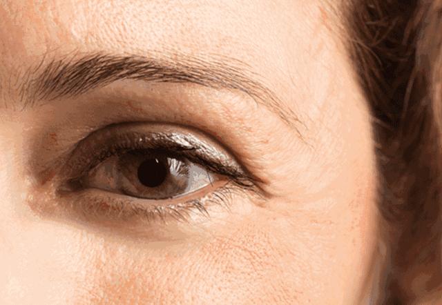 大眼袋眼纹抹平了,眼纹医美怎么去除