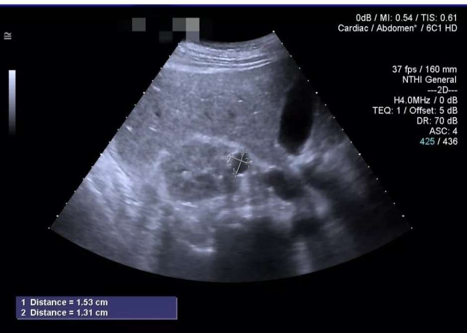 深度｜B超查出肾囊肿怎么办？什么情况需要处理？莫慌，请看此文