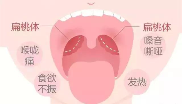 扁桃体化脓是什么原因,扁桃体化脓蒲地蓝自愈