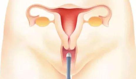 鏃╁瓡鑵归儴b瓒呭拰闃磋秴鐨勪紭缂虹偣,鑵归儴b瓒呭拰闃磋秴鐨勪紭缂虹偣