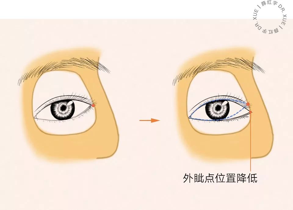 要不要开下眼睑,要不要开内眦赘皮