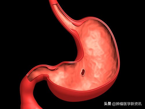 与胃癌做斗争,胃癌的治疗与前沿进展