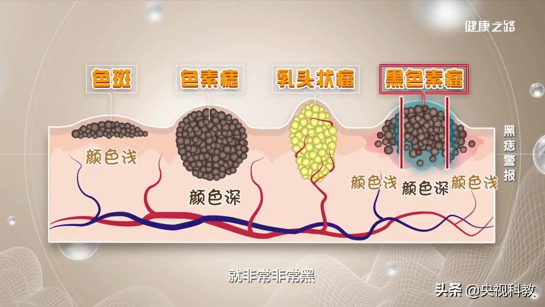 黑痣很容易恶变吗,身上黑痣出现什么状况有癌变发生