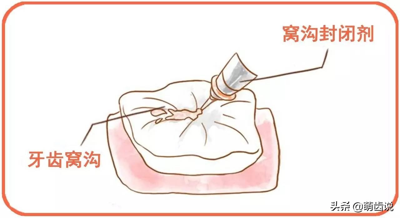 宝宝六龄牙怎么保护,六岁孩子牙做什么保护