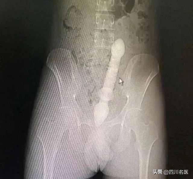 一条罗非鱼“游”进肛门？医生：直肠不直，进去容易出来难