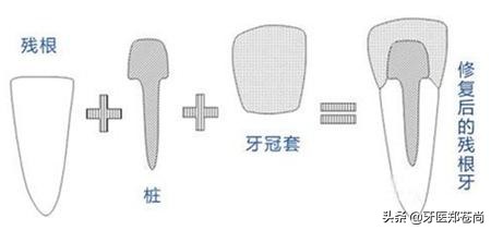蛀牙只剩根了好拔吗,蛀牙只剩牙根怎么办还能补牙么