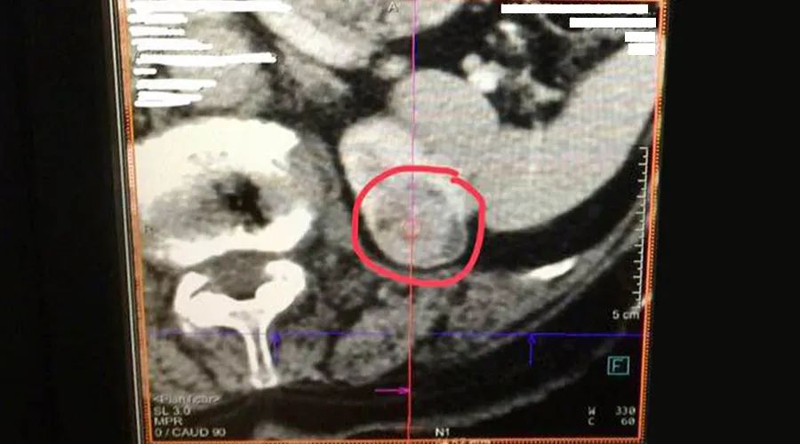 赛诺微射频消融仪,赛诺微射频消融