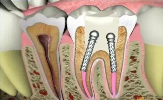 牙齿的普通治疗与根管治疗,根管治疗最严重的牙齿